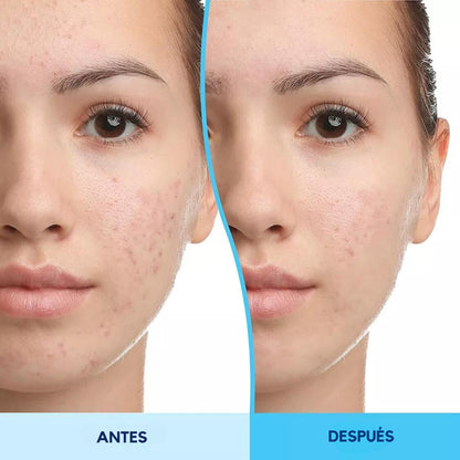 Gel Differin Adapalene Tratamiento Antiacné 0.1% Tipo De Piel Sensible, Acneica